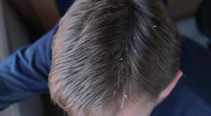 Aprenda a tratar a caspa!