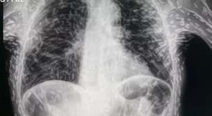 Após raio-X com tênia viralizar, entenda diferença entre cisticercose e solitária