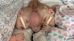 Gêmeas siamesas com 2% de chance de sobrevivência se formam no jardim de infância