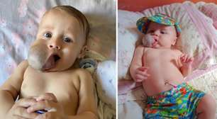 Vaquinha para salvar bebê com tumor no rosto arrecada mais de 200 mil em menos de 3 horas!