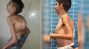 Graças à vaquinha, menino com grave caso de escoliose tem vida mudada!