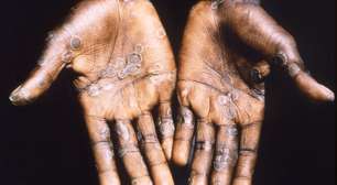 Doenças eliminadas por vacinas matavam mais que guerras mundiais