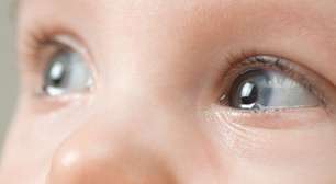 Olhos azuis e grandes de bebê eram, na verdade, sinal de uma doença rara
