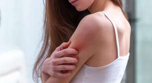 Aprenda a evitar as doenças de pele mais comuns do verão