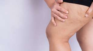 Lipedema: saiba o que é e quais os sintomas
