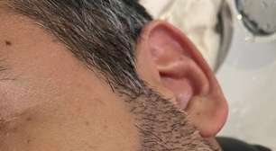 Transplante de barba cresce no mercado masculino