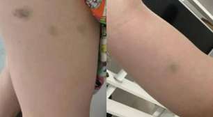 Caso Naiara Azevedo: fotos mostram hematomas causados pelo ex