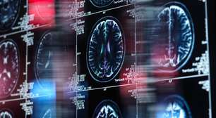 As descobertas que mudam o que sabemos da importância do tamanho do cérebro para inteligência humana