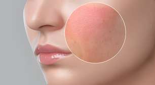 Alergia a maquiagem: como evitar e tratar o problema