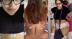 Influenciadora remove costelas em cirurgia, sofre 5 desmaios e choca ao mostrar hematomas no corpo: 'Cintura pequena'