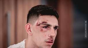 Jogador argentino do Fortaleza diz ter levado 13 pontos no rosto após ataque a ônibus