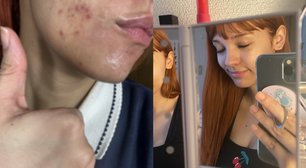 Jovem desenvolve acne após usar ácido no skincare e faz alerta