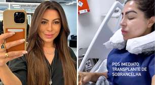Andressa Ferreira explica o processo de transplante de sobrancelha. Fotos!