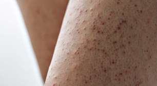 Pernas de morango: como tratar os poros escuros que surgem na região