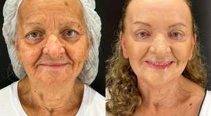'Meus familiares não me reconheceram', diz mulher de 65 anos que fez peeling de fenol