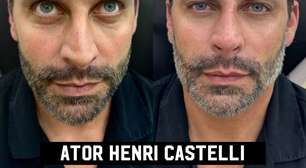 Henri Castelli faz harmonização facial; veja o antes e depois