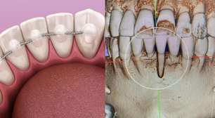 Por que a contenção higiênica nos dentes pode causar até a extração?