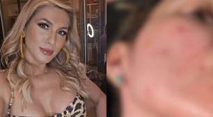 Vida real! Lívia Andrade mostra crise de rosácea na pele durante as gravações