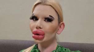6 cirurgias em um dia e 30 injeções de ácido hialurônico: mulher com os maiores lábios do mundo choca web e recebe alerta de médicos
