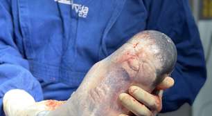 Ceres: mulher que teve três perdas gestacionais consecutivas dá à luz a bebê empelicado