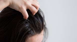 Psoríase no couro cabeludo: doença pode causar queda capilar