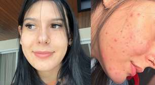 Antes e depois de Ana Castela: sertaneja faz tratamento contra acne e mostra mudança radical na pele. Compare!