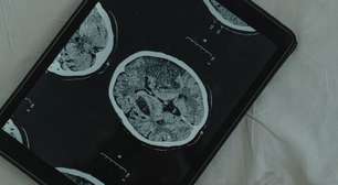 Casos de Alzheimer sem sintomas intrigam cientistas