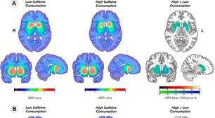 Café afeta dopamina no cérebro de pessoas com Parkinson