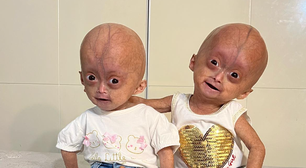 São brasileiras e as únicas do mundo: gêmeas com síndrome de velhice precoce completam 3 anos