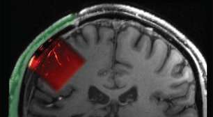 Paciente usa implante de plástico transparente que mostra o cérebro