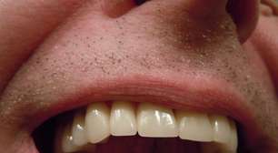 5 fatores que deixam os dentes amarelos e como evitar