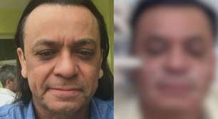 '53 com carinha de 33': Frank Aguiar faz nova harmonização facial e mostra o antes e depois