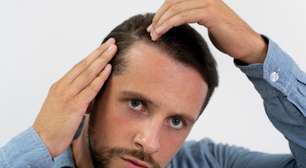 Minoxidil nos cabelos: versão em comprimido tem o mesmo efeito