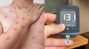 MPOX: como pode afetar pessoas com diabetes e quais são os riscos