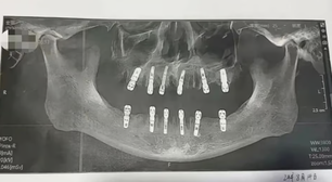 Homem chinês morre após extrair 23 dentes e implantar 12 no mesmo dia