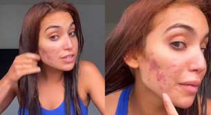 Má alimentação e remédios psiquiátricos: Vanessa Lopes revela o que causou acne severa aos 23 anos