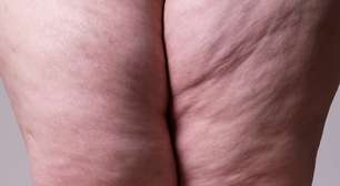 Lipedema afeta mais que a beleza!