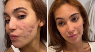 Vanessa Lopes mostra evolução em tratamento da acne: 'Doendo bem menos'