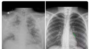 Diferença entre pulmão destruído por vape e órgão saudável surpreende em raio-x; veja