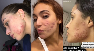 Vanessa Lopes, Ana Castela, Virginia e mais famosas que lutam contra a acne e falam abertamente sobre autoestima