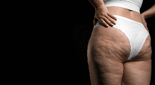 Lipedema: conheça tratamentos estéticos para controlar condição