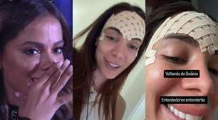 O que é a veia frontal que Anitta removeu com laser?