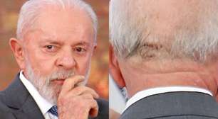 Cicatriz de Lula: É possível recuperar fios perdidos em áreas cicatrizadas com transplante capilar?