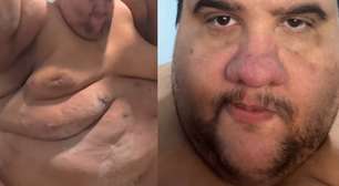 Morre Gabriel Freitas, influenciador que já pesou 380kg e compartilhava seu emagrecimento nas redes