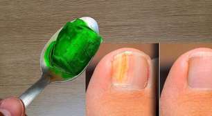 Como eliminar micose da unha: técnica fácil que aprendi com uma manicure