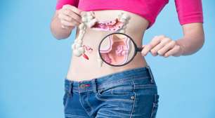 Câncer de intestino em jovens: estudo aponta as principais causas