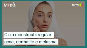 Ciclo menstrual irregular aumenta prevalência de acne, dermatite e melasma