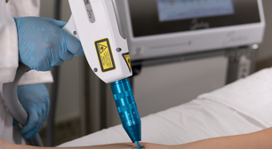 Procura por remoção de tatuagens cresce no Brasil