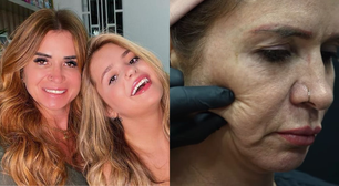 Mãe de Viih Tube faz cirurgia no rosto e resultado impressiona: '20 anos a menos'