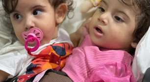 Gêmeas siamesas Kiraz e Aruna passam por cirurgia de separação em Goiânia